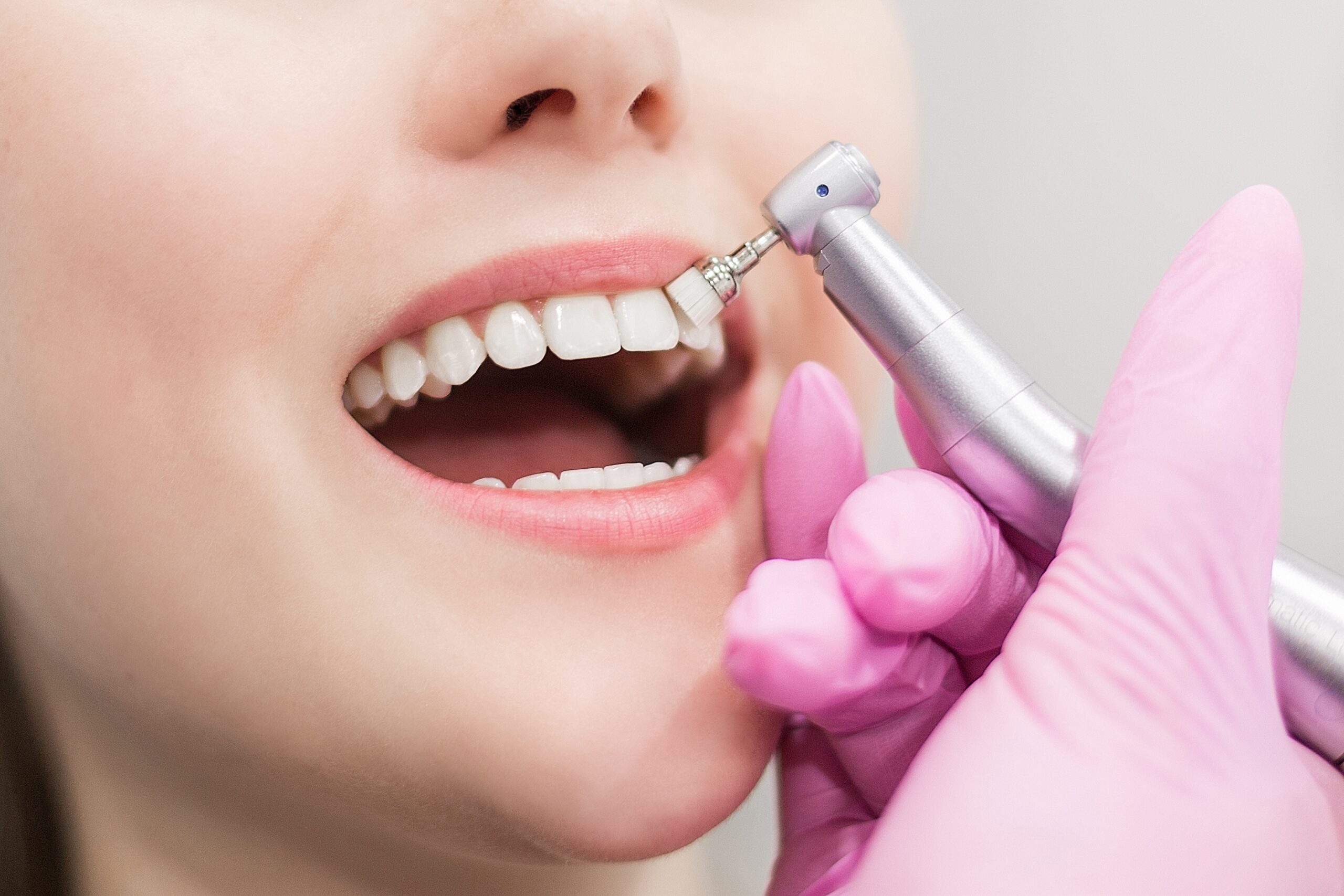 dentist-brushes-teeth-young-girl-teeth-whitening-2022-11-15-05-20-50-utc